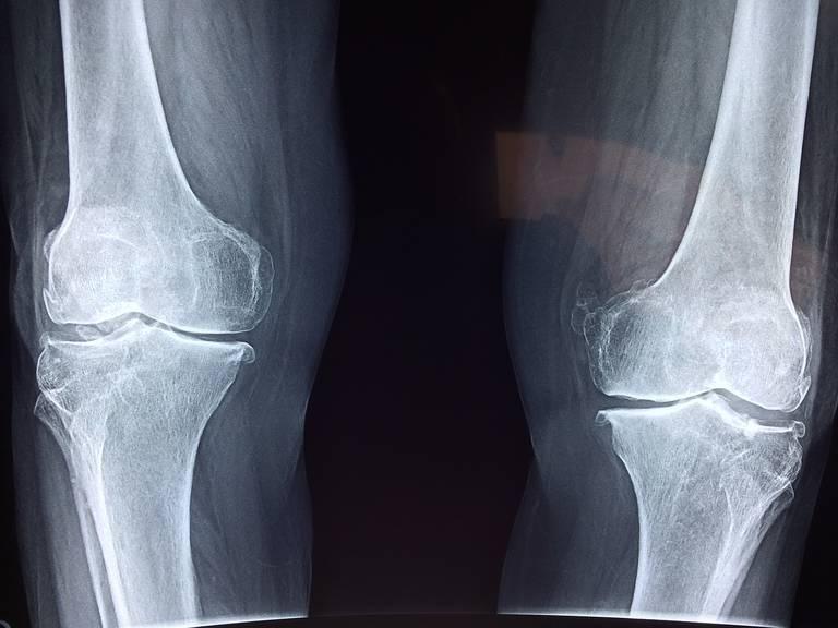 knee-2253047_1280.jpg